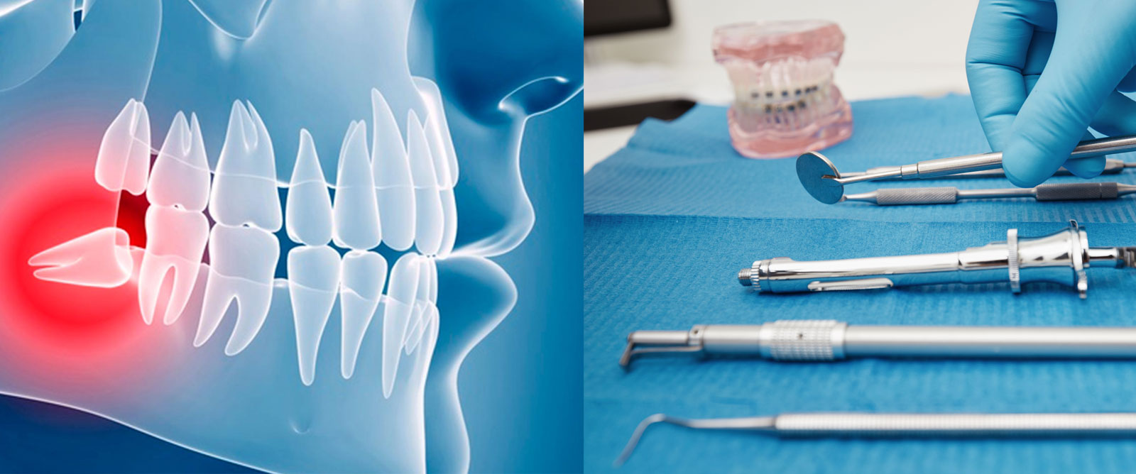 Cirugía oral en dentistas en Albacete