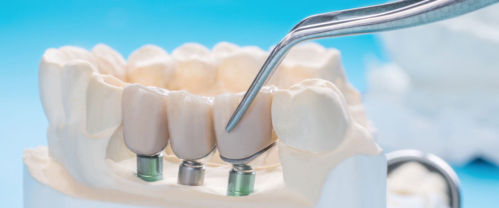 ¿Cómo se realiza un implante dental?